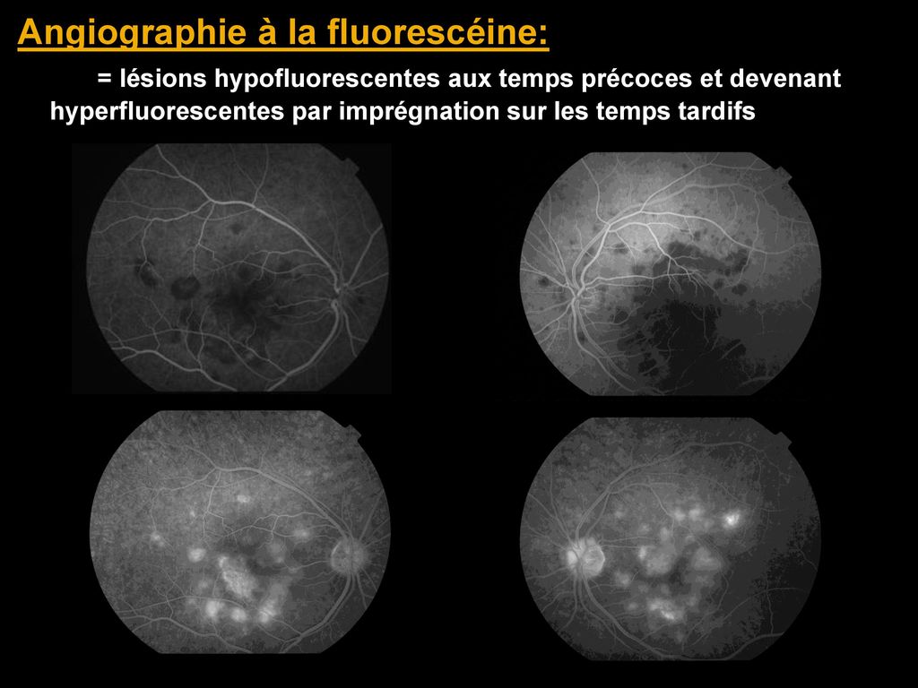 APPORT DE LA TOMOGRAPHIE PAR COHERENCE OPTIQUE DANS LA COMPREHENSION DE